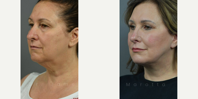 Woman treated with Laser Resurfacing - BlepharoplastyDeep Plane FaceliftFat GraftingLaser or Renuvion Skin ResurfacingSeptorhinoplasty