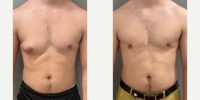25-34 year old man treated with Gynecomastia Surgery - 30 yo s/p liposuction and gland excision treatment of gynecomastia performed in our on site AAAA certified operating suite under local anesthesia with sedation
