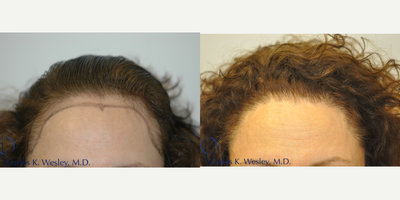 45 - 53 year old woman treated with Hair Transplant - FUT procedure