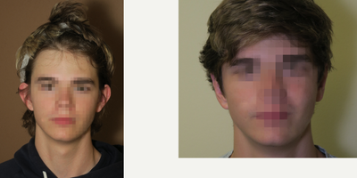 18-24 year old man treated with Ear Surgery - otoplasty