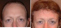 Woman treated with Hair Transplant - Woman treated with Hair Transplant for hairline lowering