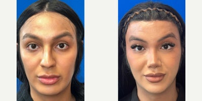 18-24 year old transgender woman treated with Facial Feminization Surgery - Facial Feminization