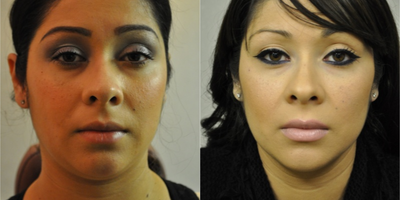 25-34 year old woman treated with Buccal Fat Removal - Buccal Fat Pad that refined cheek and jawline