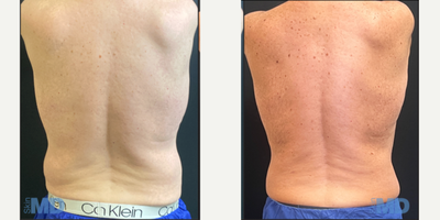 45-54 year old man treated with Skin Tightening - Dr. Ko performed Liposuction and Skin Tightening on this patient. Skin MD is the #1 provider of InMode's BodyTite, FaceTite + Morpheus in Massachusetts - 2022.