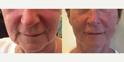 45-54 year old woman treated with Silhouette InstaLift - Immediate photo after Silhouette InstaLift and 1 cc Restylane lip augmentation