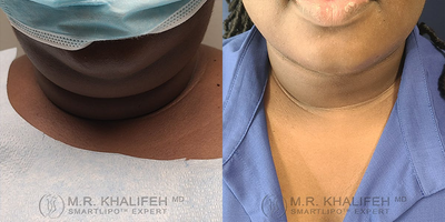25-34 year old woman treated with Laser Liposuction - A young lady with excellent skin was treated with smart Lipo of the neck to debulk the fat deposits forlower face contour.