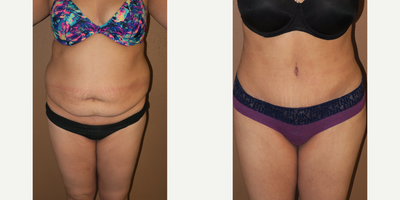 25-34 year old woman treated with Liposuction - Abdominoplasty, Liposuction of the abdomen and flanks, and brazilian buttocks lift