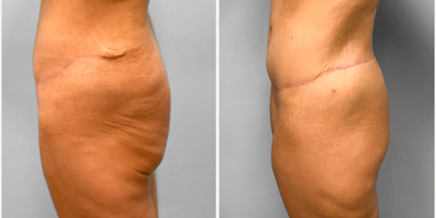 35-44 year old woman treated with Body Lift - This woman in her mid-thirties previous had a tummy tuck procedure performed by Dr. Howell and returned to discuss further contouring options. She chose to proceed with a lower back and buttocks lift. Her contours look great, and she has been extremely happy with her results. The pictures feature her before and three months after surgery.