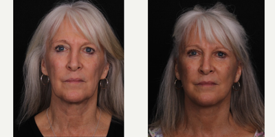 65-74 year old woman treated with Facelift - Female patient 1 month after facelift.