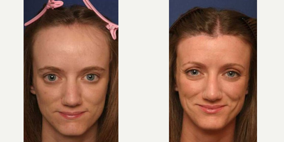 Forehead Reduction - Forehead Reduction (Hairline Lowering)