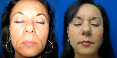 45-54 year old woman treated with Radiesse - Radiesse facial filler 1 day post injection