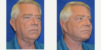 55-64 year old man treated with Cheek Augmentation - This gentleman came in wanting to correct the sagging skin at his neck and jowls and add natural volume to his face. After visiting with Dr. Ho, the patient elected to have a face/neck lift and cheek implants.