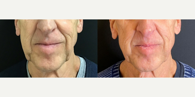 65-74 year old man treated with FaceTite - Accutite to the the nasolabial folds and jowls.