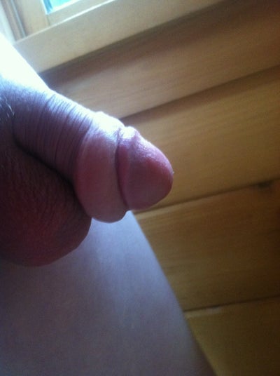 Growth On My Penis 116