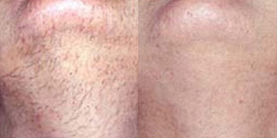 Man treated with Laser Hair Removal - Man treated with Laser Hair Removal