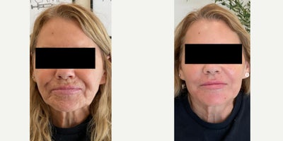 55-64 year old woman treated with RHA Collection Fillers, Skin Rejuvenation, Dysport, Sculptra - For this patirent 40 units of dysport and 2 vials of Scultpra was used during the 1st seating. During second seating, 2 vials of sculptra. Temples, cheeks, NLF, chin shadowing. 4 syringe face rejuvenation using RHA was used for the third seating to achieve these amazing results!