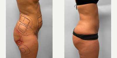 25-34 year old woman treated with Butt Lift, Liposuction - This woman in her early thirties met with Dr. Howell to discuss her interest in body contouring. SmartLipo to the abdomen, flanks and saddle bag areas along with BBL fat injections to the lateral buttocks would help her achieve her desired appearance while being a less invasive option for surgery. She has nice contours to her abdomen, flanks and buttocks and is pictured before and three months after surgery.