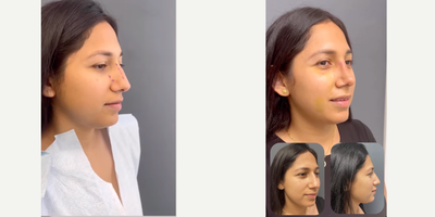 25-34 year old woman treated with Rhinoplasty - Another rhinoplasty reveal!
