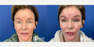 55-64 year old woman treated with Facial Fat Transfer, Thread Lift - The patient is a 62 year-old female who had concerns with facial volume loss and bilateral brow ptosis. Dr. Cho performed fat grafting to the face and Novalift to the brows.After photos are 1 month post procedure.