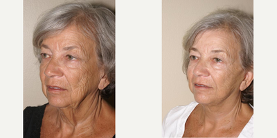 65-74 year old woman treated with Facelift - Face lift, neck lift performed by Dr. Wisnicki.This is a 72 year old woman who underwent treatment under local anesthesia for improvement of facial folds and better definition of her neck and jaw lines. She was very pleased with the outcome.