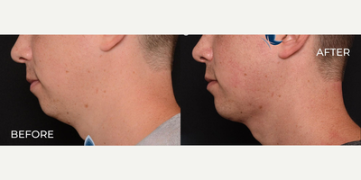 Man treated with Chin Implant - Man treated with Chin Implant