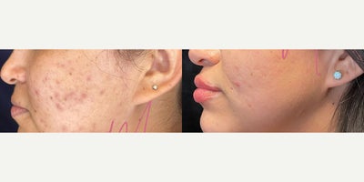 35-44 year old woman treated with Facial, Chemical Peel, Microneedling - Series of 3 with Alyssa G.