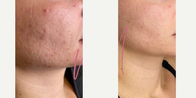 35-44 year old woman treated with Facial, Microneedling - Series of 3 with Alyssa G.