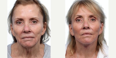 65-74 year old woman treated with Facelift, Lip Lift, CO2 Laser, Laser Resurfacing - This 65-year-old patient presented with excess skin, jowling, volume loss, and significant sun-damaged, aging skin. She underwent a facelift with fat transfer, a lip lift, and CO laser resurfacing to address both structural support and surface texture. Her after photos show smoother skin, restored facial volume, and a more defined, youthful facial contour.