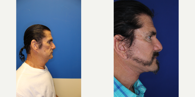 55-64 year old man treated with Deep Plane Facelift - Complete rejuvenation of the neck just 4 months after Deep plane facelift.