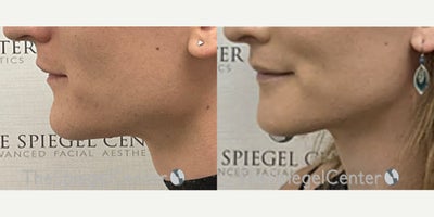 25-34 year old transgender woman treated with Jaw Surgery - 25-34 year old transgender woman treated with Jaw Surgery