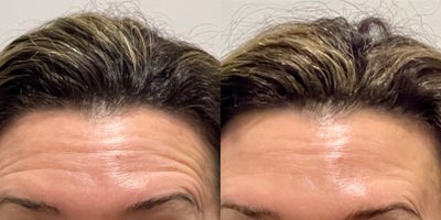 35-44 year old woman treated with Botox - 15 units of Botox to treat horizontal lines