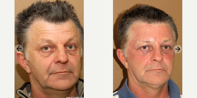 Man treated with Eyelid Surgery - Man treated with Eyelid Surgery