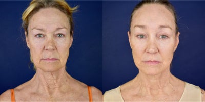65-74 year old woman treated with Deep Plane Facelift, Neck Lift, Brow Lift, Eyelid Surgery, Lip Lift, Canthoplasty - This female patient had a previous upper and lower eyelid surgery and forehead lift 10 years ago. She had a wrinkle neck, fallen cheeks, jowls and dropping jawline, she has a very active platysma bands and tired expression. Her eye brow position droops. Dr. Valdez performed a Deep lip lift, Deep Plane Facelift and Necklift, Platysmoplasty, lower and upper blepharoplasty, cnathoplasty, endoscopic browlift and forehead lift and micro and nano facial fat grafting. Now she has 5 months after her surgery.