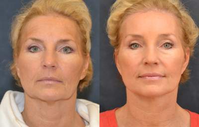 45-54 year old woman treated with Chemical Peel - minilift, 35% tca peel, smas to lips