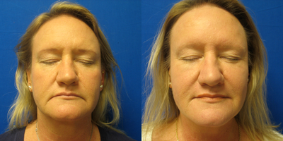 45-54 year old woman treated with Radiesse - Radiesse injection