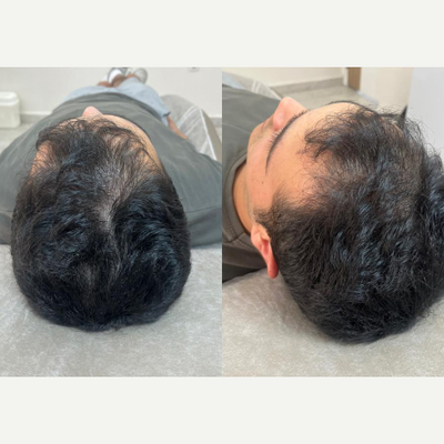 25-34 year old man treated with Mesotherapy - 4 times hair mesotherapy with hair treatment solution