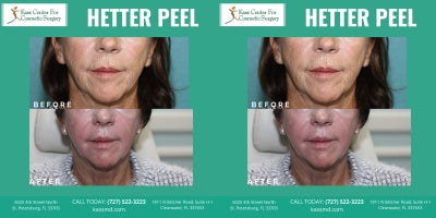 65-74 year old woman treated with Chemical Peel - 2 Week Post-Op: Hetter Peel Transformation Look at the difference of just 2 week post-Hetter Peel!This powerful phenol-croton oil peel penetrates deep to: Smooth fine lines & wrinkles. Reduce sun damage & pigmentation. Improve skin texture & tightness. After just 7 days, our patients skin is already: Clearer, firmer, noticeable rejuvenated and wrinkles are gone!