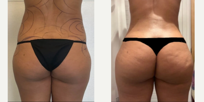 35-44 year old woman treated with Liposuction - Tired of feeling insecure about the size and shape of your buttocks? Dr. Meegan Gruber's Gruber Booty (BBL) with Awake lipo and fat transfer to hip can help you achieve a more curvaceous, shapely figure. The before and after photos of Dr. Gruber's patients speak for themselves - this procedure can make a transformative difference in the contours of your buttocks, giving you the confidence to show off your curves. Trust Dr. Gruber's expertise and experience to give you the results you deserve. Book your appointment today and take the first step towards the body you've always wanted!