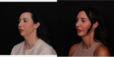 35-44 year old woman treated with Neck Lift, Chin Implant, Facial Fat Transfer, Rhinoplasty - Beautiful results for our patient now 3 months after deep neck lift, chin implant, facial fat grafting, and subtle rhinoplasty! We rebalanced her by contouring the deep neck structures and glands and adding volume to her temples, along the jawline, near her chin, and elsewhere. We also added a chin implant to extend her jawline. She is healing so well and has been a gem! Thanks to her for letting us share and continuing to be patient with the healing process!