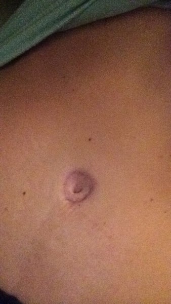 My belly button is still so ugly after tummy tuck and ...