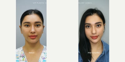 35-44 year old woman treated with Rhinoplasty, Asian Rhinoplasty, Revision Rhinoplasty - Revision rib cartilage rhinoplasty with mid face augmentation - performed by Dr. Myung Ju Lee.This patient previously had rhinoplasty with silicone implant, and chief complaints include high bridge with un-natural side profile. With 100% autologous rib cartilage, a revision rhinoplasty was performed creating a balanced angle.
