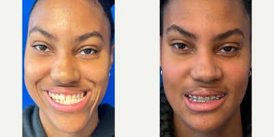 18-24 year old woman treated with Facial Reconstructive Surgery - Triple Jaw Surgery to Correct Malocclusion and Improve Facial Harmony