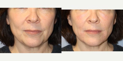 55-64 year old woman treated with Vampire Facelift - 15014: Vampire Face Lift of lower face (nasolabial fold, marionette lines, commissures, pre-jowl sulcus) 1 syringe RHA2, 15cc PRP 57 y/o F, 54, 145 lbs