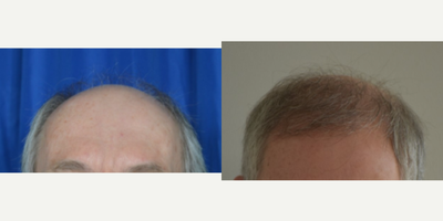 55-64 year old man treated with Artas Robotic Hair Transplant - Metairie, Louisiana man treated with ARTAS Hair restoration by Dr. Sean Weiss