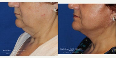 65-74 year old woman treated with Facelift, Neck Lift - Patient wanted to get rid of facial laxity and jowls.