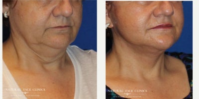 65-74 year old woman treated with Facelift, Neck Lift - Patient wanted to get rid of facial laxity and jowls.