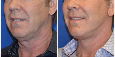 55-64 year old man treated with Facelift - Facelift