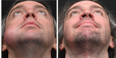 35-44 year old man treated with Lipoma Removal - This patient had a facial lesion for several years before coming to see us. We were able to remove this lesion entirely through an incision in the mouth (without any external incisions)! Here are his photos at only 1 week after lesion removal.