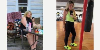 35-44 year old woman treated with Gastric Bypass - Gastric Bypass surgery with Dr Alejandro Lopez