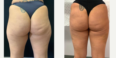 35-44 year old woman treated with Laser Liposuction - Power Assisted Liposuction Abdomen, Outer Thighs